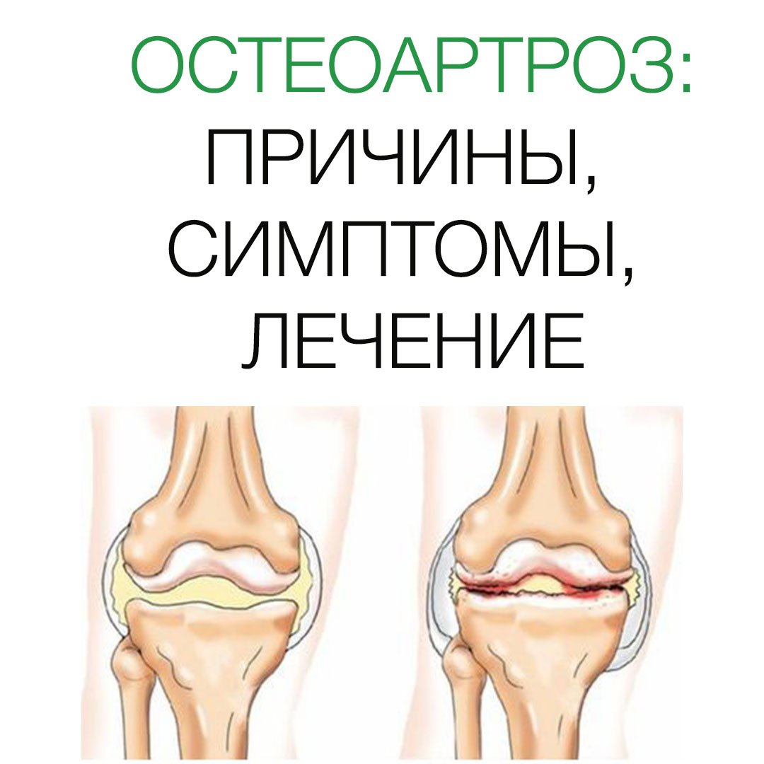 Остеоартроз это. Локализованный остеоартроз. Симптоматика остеоартроза.